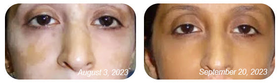 đDobshow⢠BeeVenom Vitiligo Treatment Cream