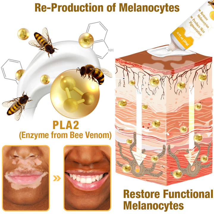 đDobshow⢠BeeVenom Vitiligo Treatment Cream