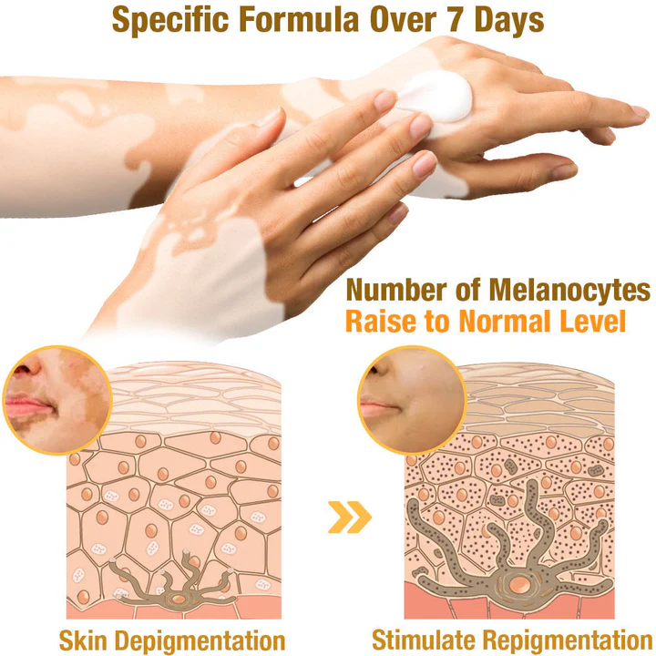 đDobshow⢠BeeVenom Vitiligo Treatment Cream