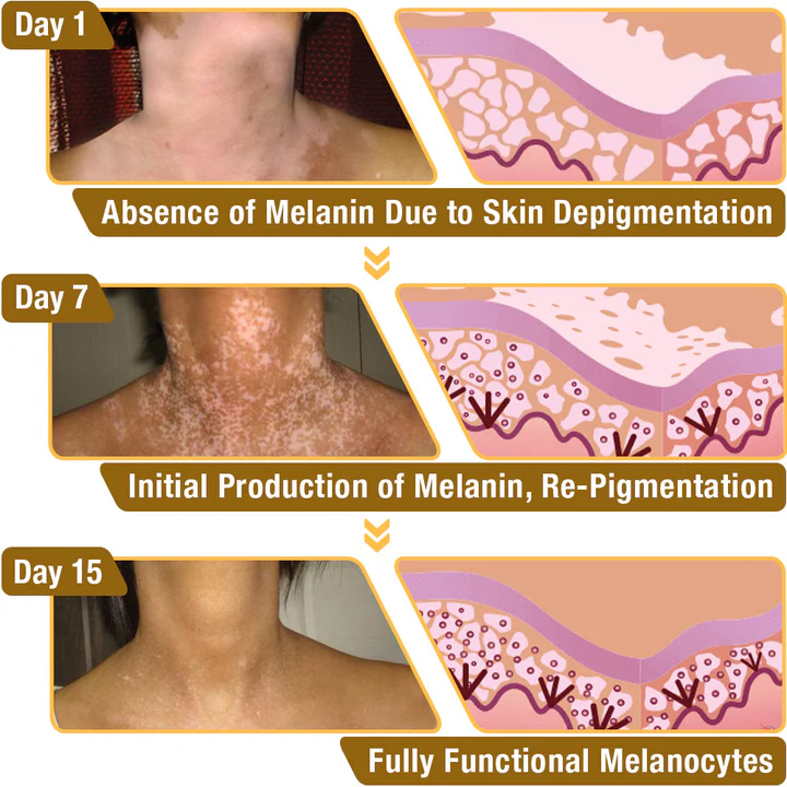 đDobshow⢠BeeVenom Vitiligo Treatment Cream