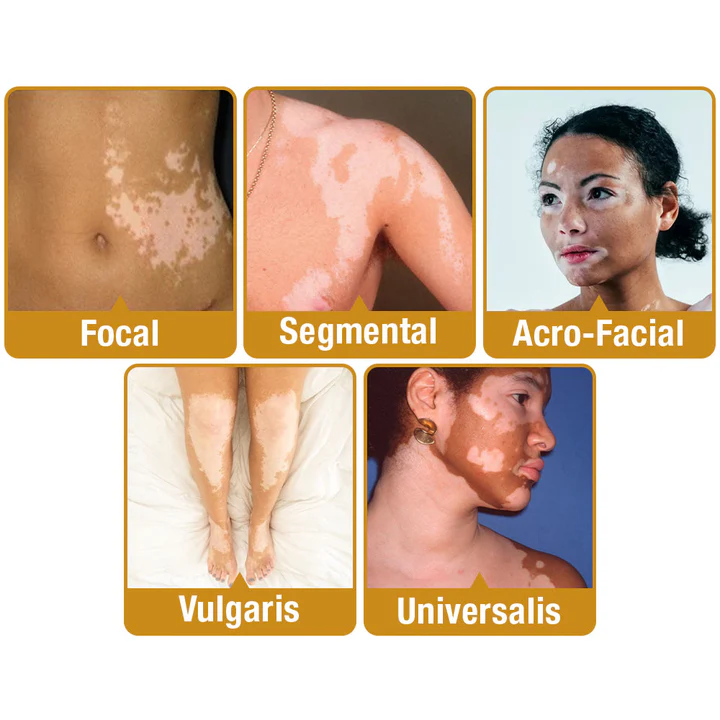 đDobshow⢠BeeVenom Vitiligo Treatment Cream