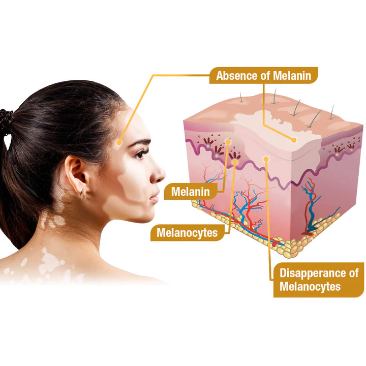 đDobshow⢠BeeVenom Vitiligo Treatment Cream