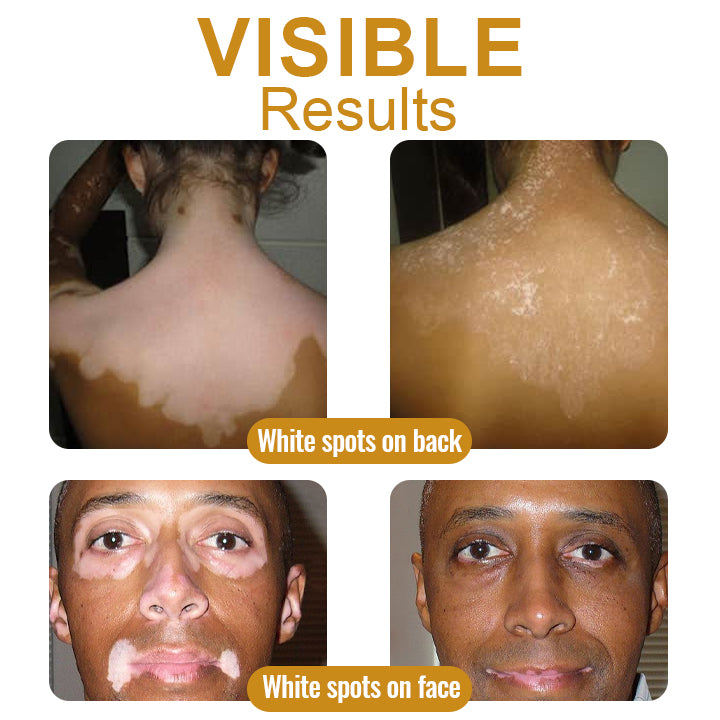 đDobshow⢠BeeVenom Vitiligo Treatment Cream