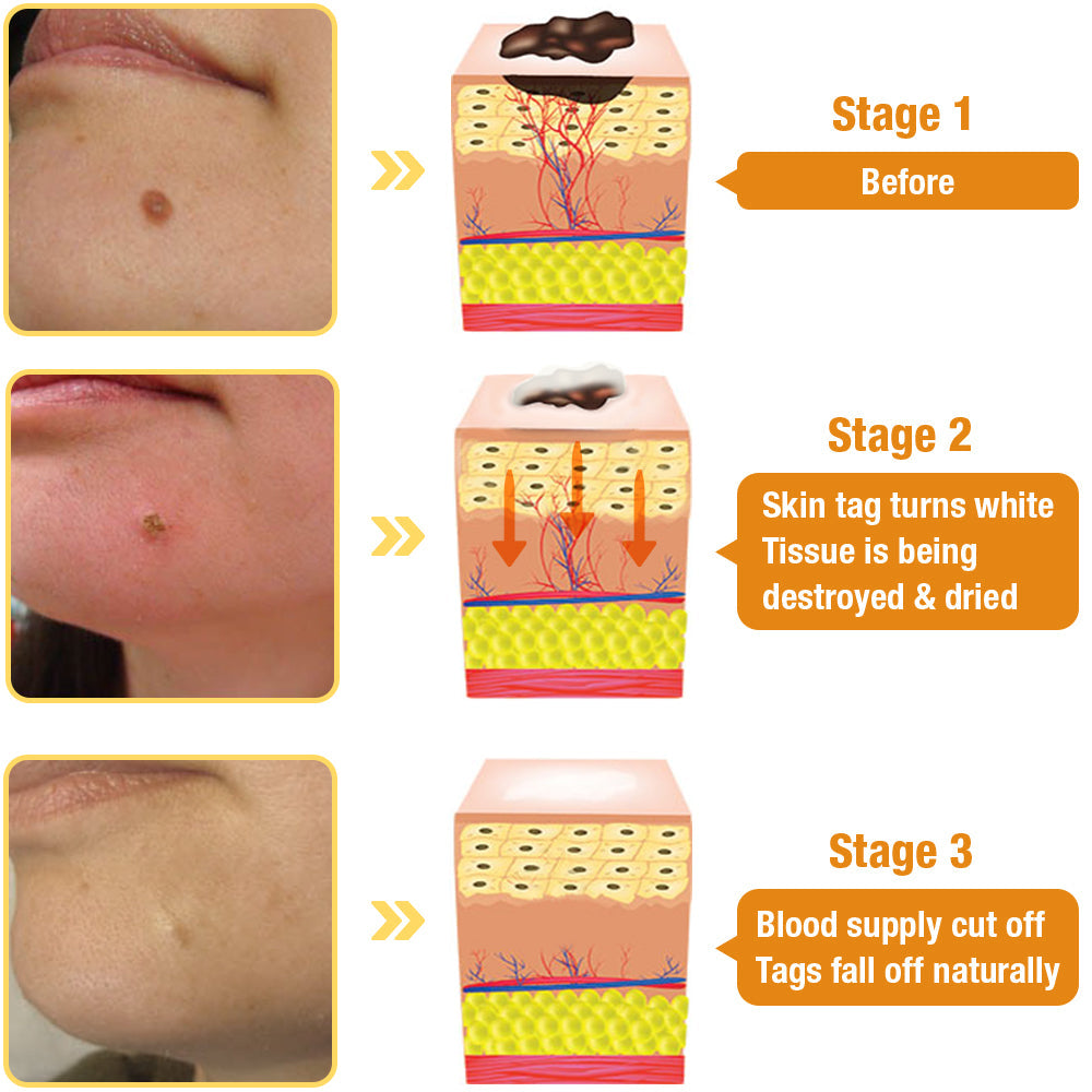 Dobshow™ Bee Venom Skin Perfection Spray: Erase Tags & Warts Naturally 🐝