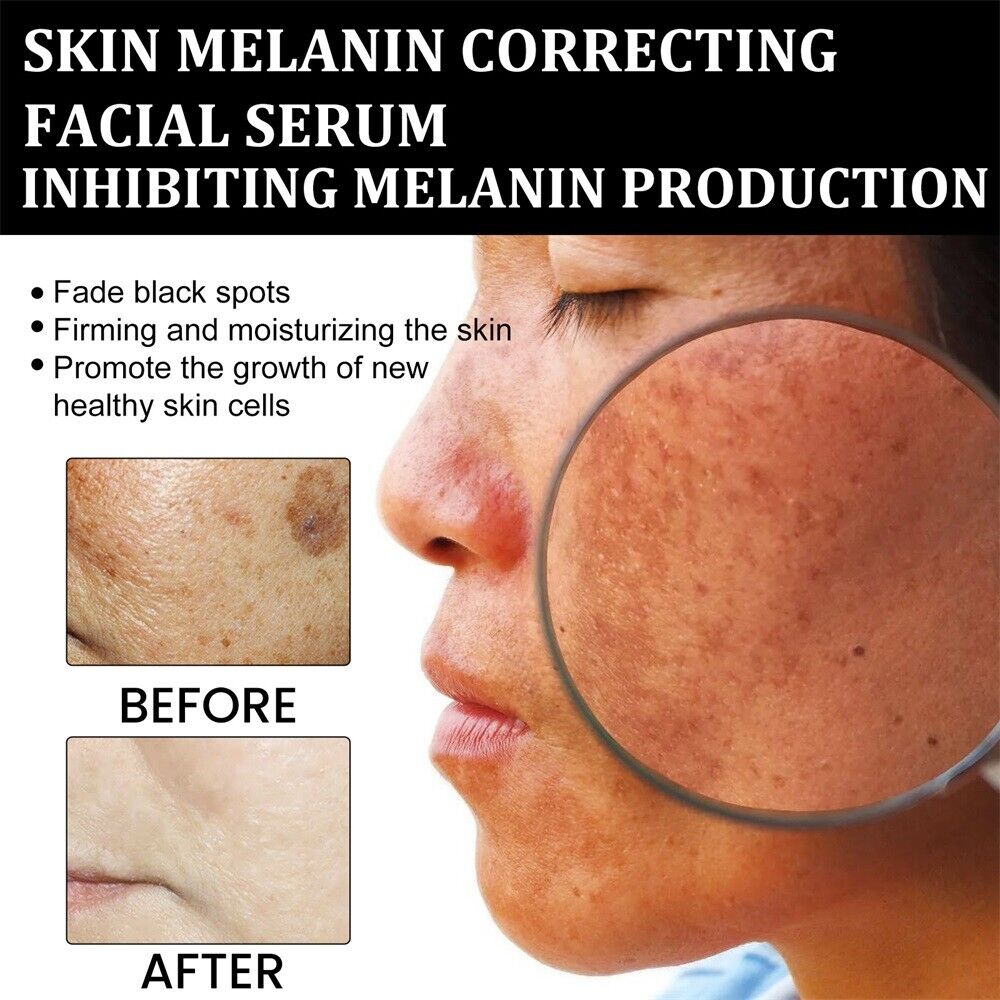 ✨Fast Dark Spot Remover-Dobshow™ Melanin Correcting Facial Serum