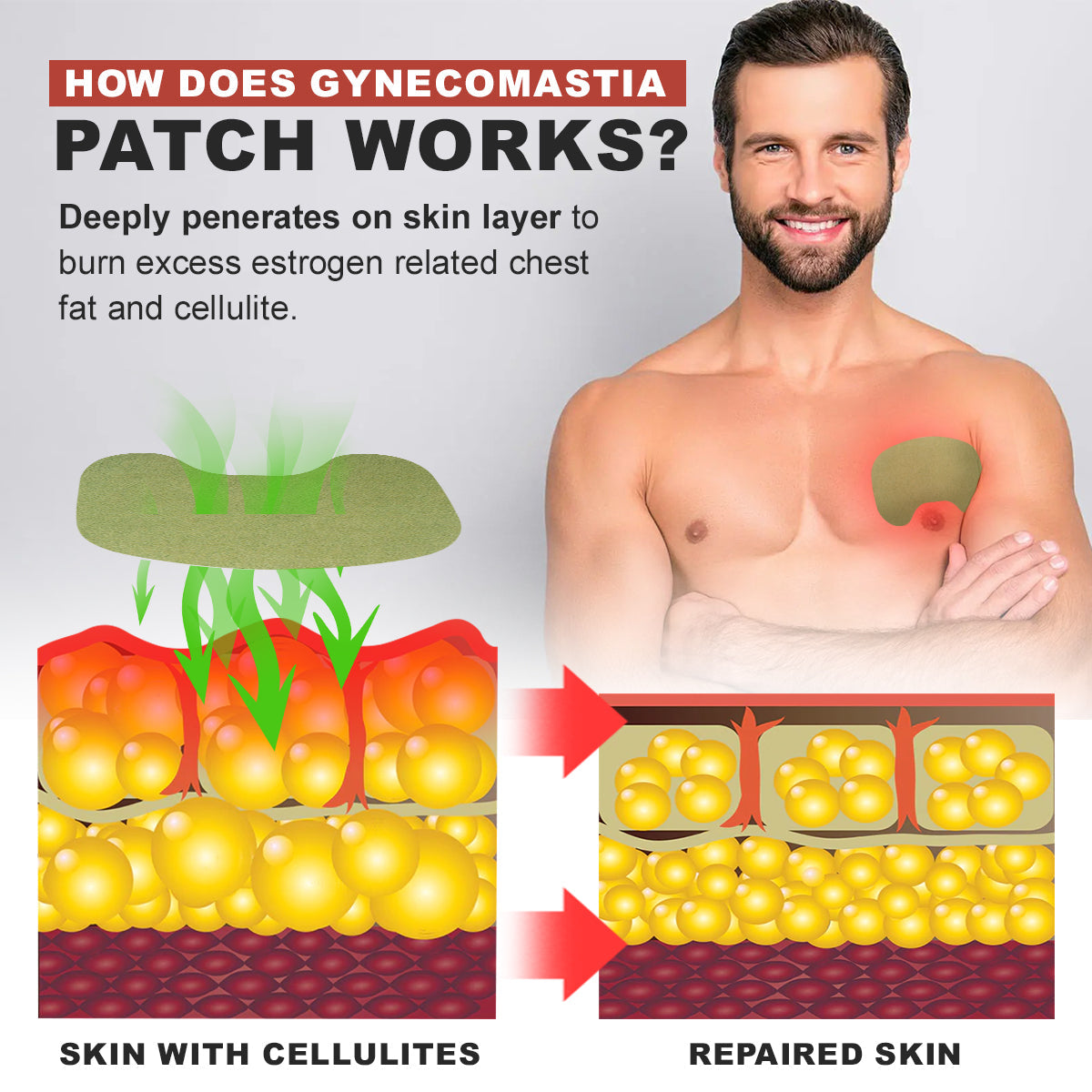 💪🌟 Nurbini™ Gynecomastia & Cellulite Reduction Patches ✨💪