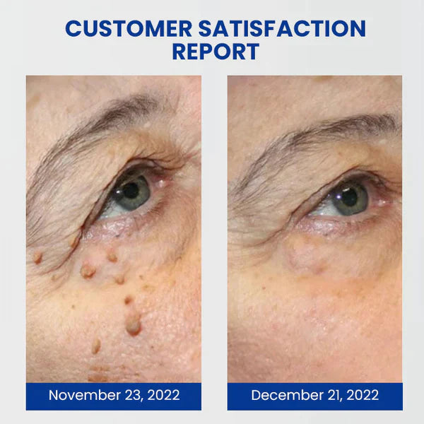 Dobshow™ WartsOff Rapid Cream for Instant Skin Impurity Removal