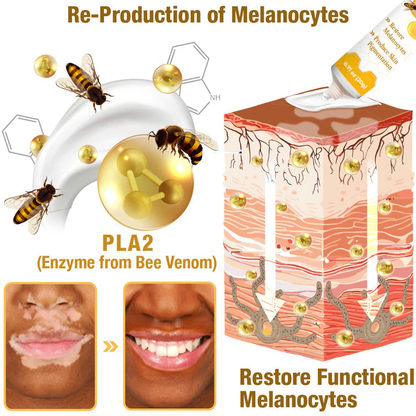 🐝Dobshow™ BeeVenom Vitiligo Treatment Cream