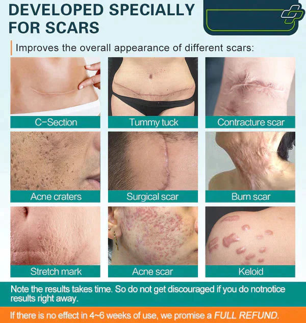 Dobshow™ LuminaHeal Precision Scar Therapy Mist-For All Types of Scars - For example Acne Scars, Surgical Scars and Stretch Marks ⚡️⚡️⚡️
